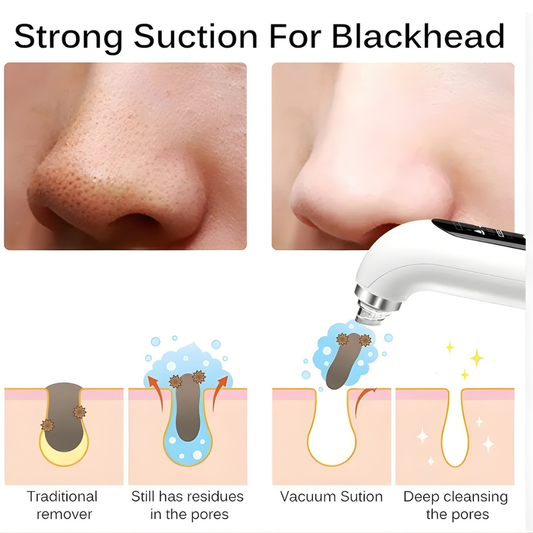 Electric Blackhead Remover – Pore Vacuum Suction Cleaner